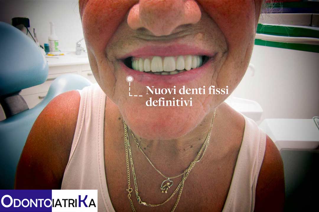 Impianti Zigomatici Odontoiatrika Savona