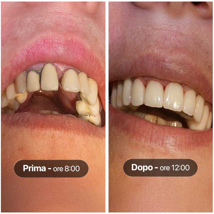 Caso clinico di nuovi denti fissi in 4 ore ad Odontoiatrika a Savona