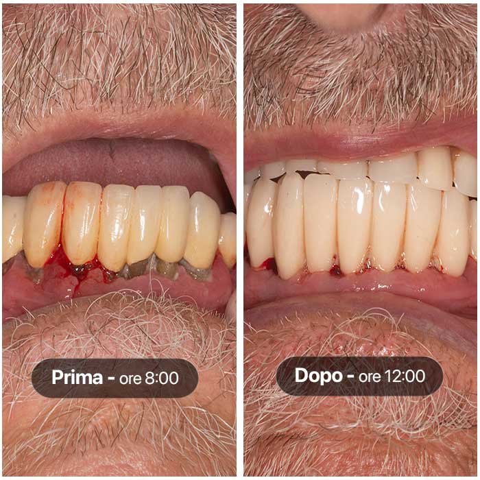 Caso clinico di nuovi denti fissi in 4 ore ad Odontoiatrika a Savona