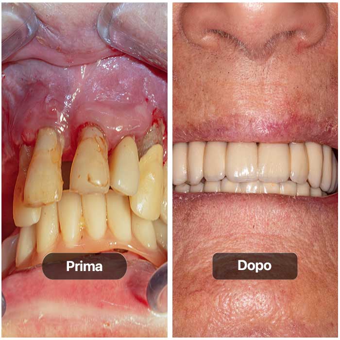 Prima e dopo caso implantare 17 di doppia arcata dentale