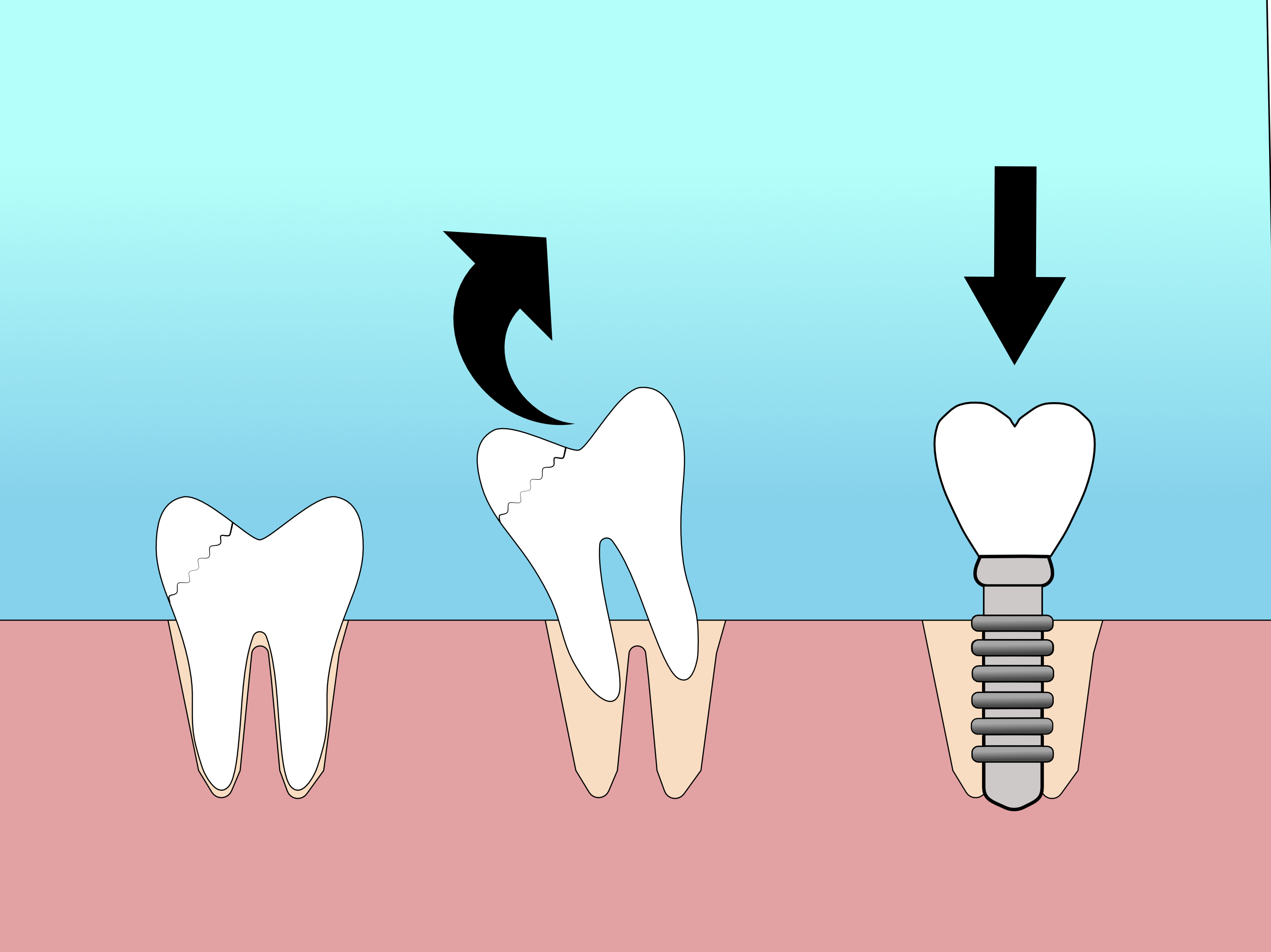 Odontoiatrica Implantologia a carico immediato