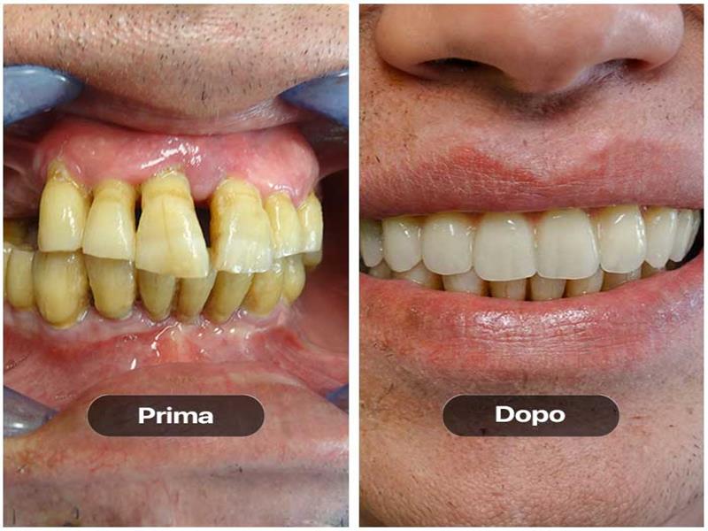 Prima e dopo di un'operazione effettuata su un paziente impiantando protesi dentali nuove