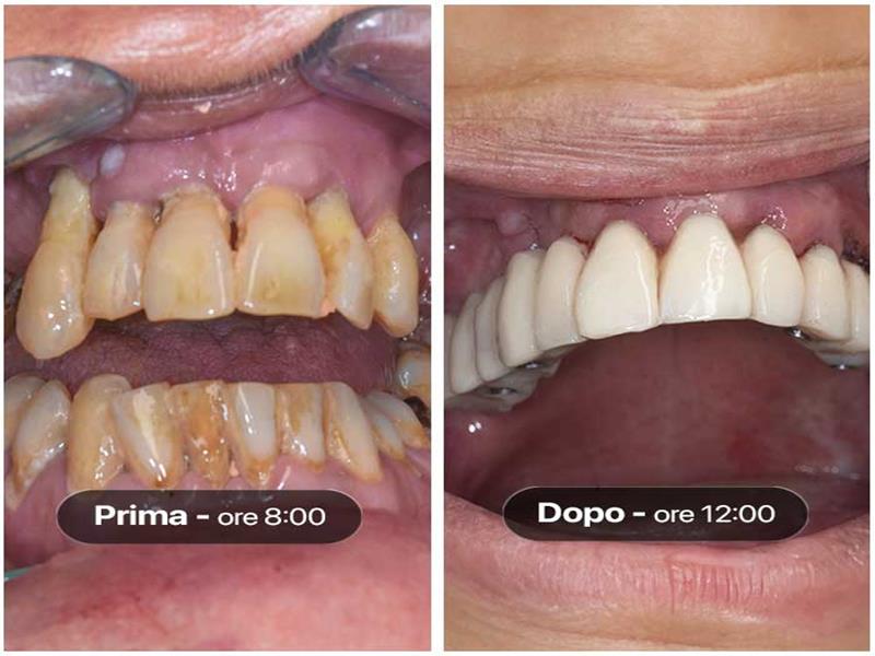 Prima e dopo sostituzione denti con protesi impiantata sull'arcata superiore