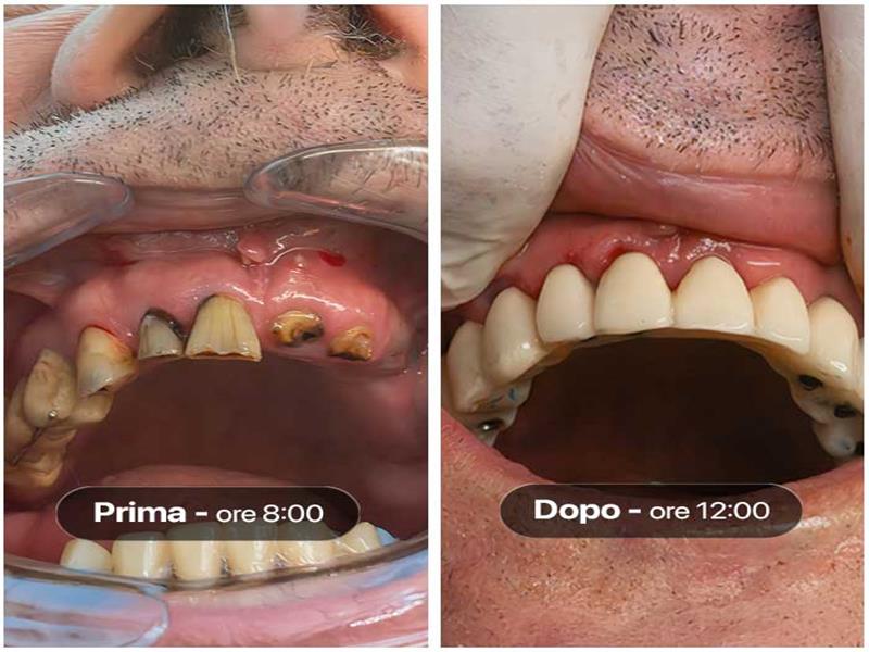 Prima e dopo di un'operazione per impiantare protesi dentali su un paziente con caso clinico complicato su arcata superiore